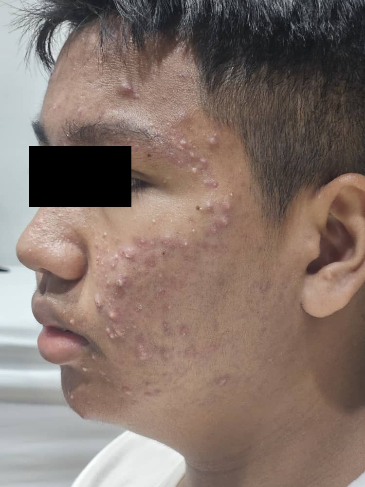 Facial acne before treatment